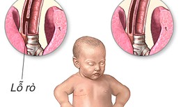 Phát hiện sớm teo thực quản
