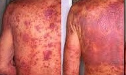 Thời tiết hanh khô, đề phòng viêm da cơ địa