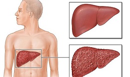 Các thuốc gây độc cho gan