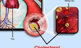 Dùng thuốc điều chỉnh rối loạn lipid máu: Cảnh giác biến cố tim mạch