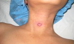 Bệnh lý khe mang - bệnh bẩm sinh vùng đầu cổ