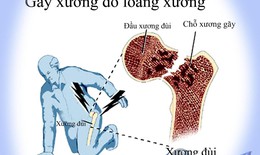 Vitamin E có thể gây ung thư tuyến tiền liệt, loãng xương?