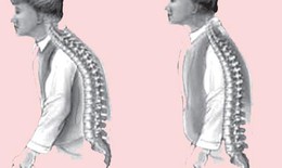 Loãng xương có nên dùng hạ áp chặn canxi?