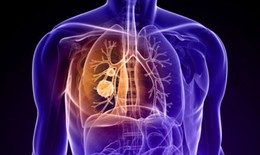 Bí quyết đơn giản phòng tránh ung thư phổi