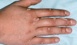Trị mụn cơm, thuốc nào tốt?