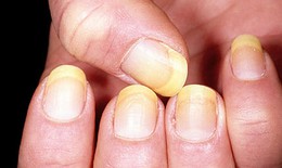 Nấm móng: Nguyên nhân, triệu chứng, cách điều trị và các biện pháp phòng ngừa