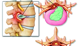 Những biến chứng thoái hóa đốt sống cổ