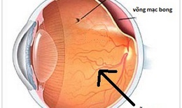 Ai dễ bị bong võng mạc?