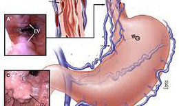 Ph&#242;ng ngừa gi&#227;n tĩnh mạch thực quản ở người bệnh gan