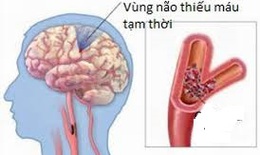 Cảnh giác với cơn thiếu máu não thoáng qua