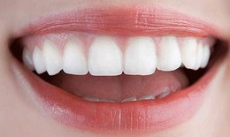 Chỉnh hình hô móm không cần niềng răng