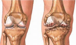 Thấp khớp cấp, thấp tim: dùng thuốc gì, vào lúc nào?