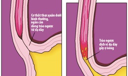 Tr&#224;o ngược dạ d&#224;y - thực quản, bệnh hay chẩn đo&#225;n nhầm