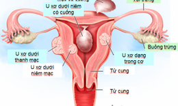 Đe dọa tính mạng vì chữa u xơ tử cung theo phương pháp dân gian