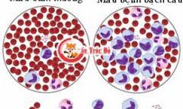 Kỳ diệu em bé thoát cửa tử khi đã bị bệnh ung thư máu