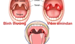 Khi n&#224;o n&#234;n cắt amiđan?