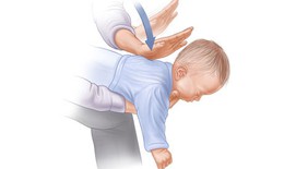 Sơ cứu suy hô hấp do dị vật đường thở ở trẻ em