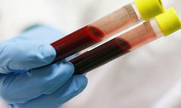 Khi kinh nguyệt có nên xét nghiệm máu?