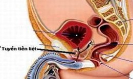 Khi nào nên phẫu thuật tăng sinh lành tính tuyến tiền liệt?