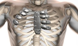 Ca mổ ghép xương ức và xương sườn 3D đầu tiên trên thế giới