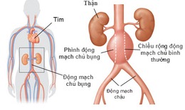 Vỡ động mạch do vi khuẩn tấn công