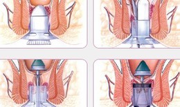 Tác hại của trĩ nội