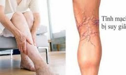 Điều trị giãn tĩnh mạch tại nhà