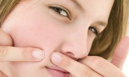 Trị mụn có nên dùng thuốc nội tiết?