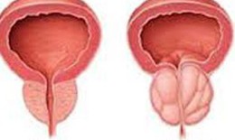 Phì đại tuyến tiền liệt có phải là ung thư không?