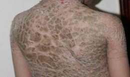 Da vảy cá vì hôn nhân cận huyết