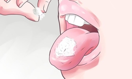 Mẹo xử trí nhanh khi bị bỏng lưỡi