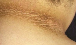 Ngấn sạm đen ở cổ vì ăn nhiều đồ ngọt
