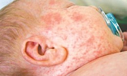 Bệnh sởi và biến chứng hô hấp