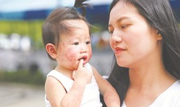 Bệnh tay chân miệng có xu hướng gia tăng: Cách chăm sóc trẻ đúng cách