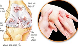 Mùa lạnh, đau nhức xương dễ tái phát