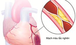 Đau ngực do phình bóc tách động mạch chủ ngực