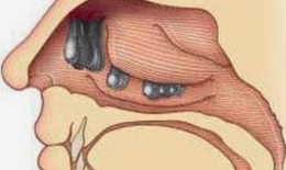 Polyp mũi