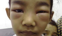Hiểm nguy do thận hư ở trẻ em