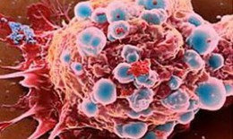 Ung thư biểu mô tế bào vảy kết mạc có hay tái phát?