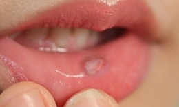 10 bài thuốc dân gian trị viêm loét miệng