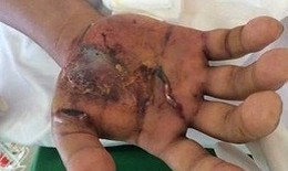 Xử trí đúng khi bị rắn cắn