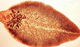 Bệnh sán lá gan dễ nhầm với ung thư gan