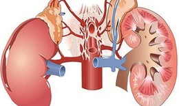 Suy thận cấp do dùng thuốc điều trị