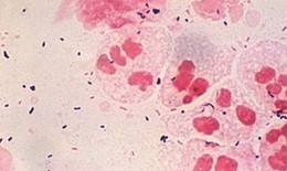 Chlamydia gây bệnh mắt hột