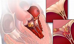 Thực hư "virus lạ" gây viêm cơ tim lây truyền từ người sang người