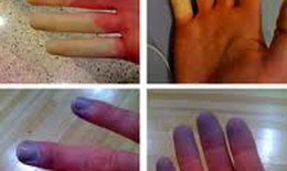Thuốc chữa bệnh Raynaud