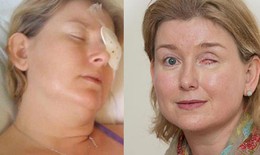 Đeo kính áp tròng, vi trùng đục thủng mắt