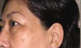 Nám má do rối loạn nội tiết tố