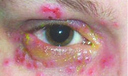 Bệnh Zona mắt
