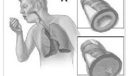 Phù mạch đường hô hấp trên do thuốc và cách đối phó